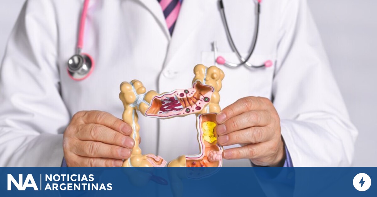 Se diagnostican casi 2 nuevos casos de cáncer de colon por hora en Argentina